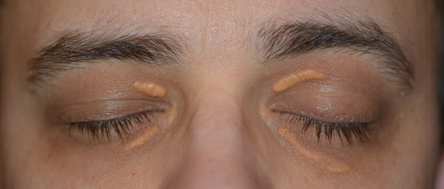 Xantelasma: quando as placas nas pálpebras indicam mais do que estética