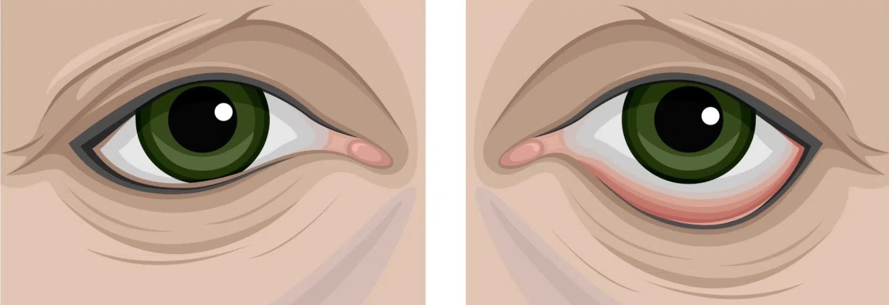Entrópio e Ectrópio: quando as pálpebras perdem sua posição natural