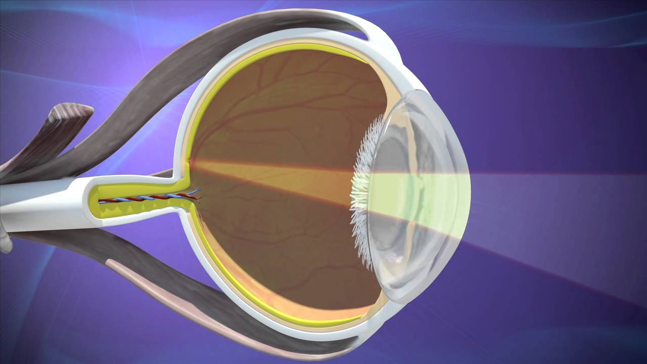 Catarata e Astigmatismo: por que tratar os dois ao mesmo tempo muda o resultado da cirurgia