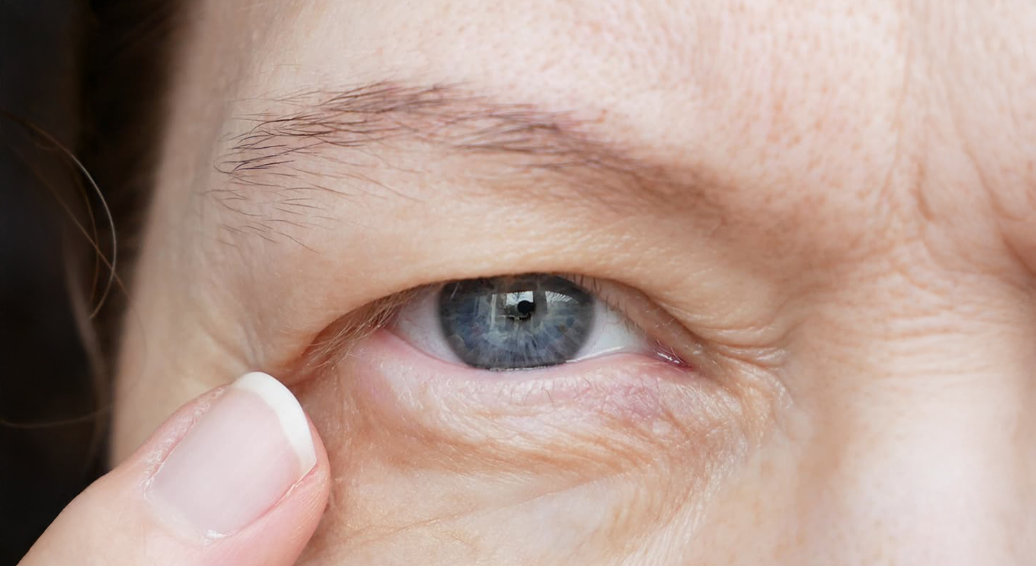 Ptose após cirurgia ocular: quando a pálpebra cai depois de um procedimento