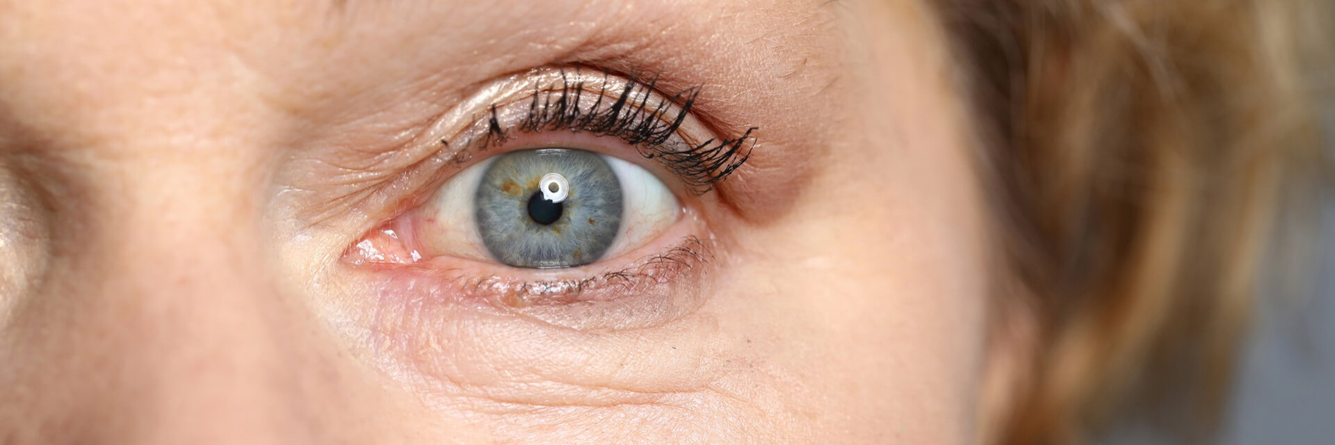Triquíase: quando os cílios crescem na direção errada e começam a machucar os olhos